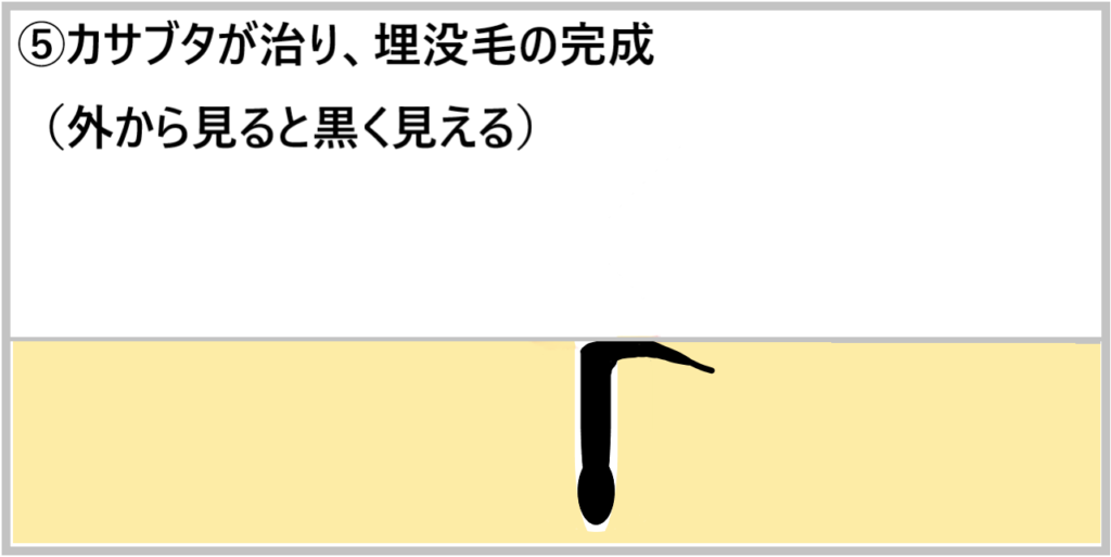 ⑤カサブタが治り、埋没毛の完成（外から見ると黒く見える）の画像