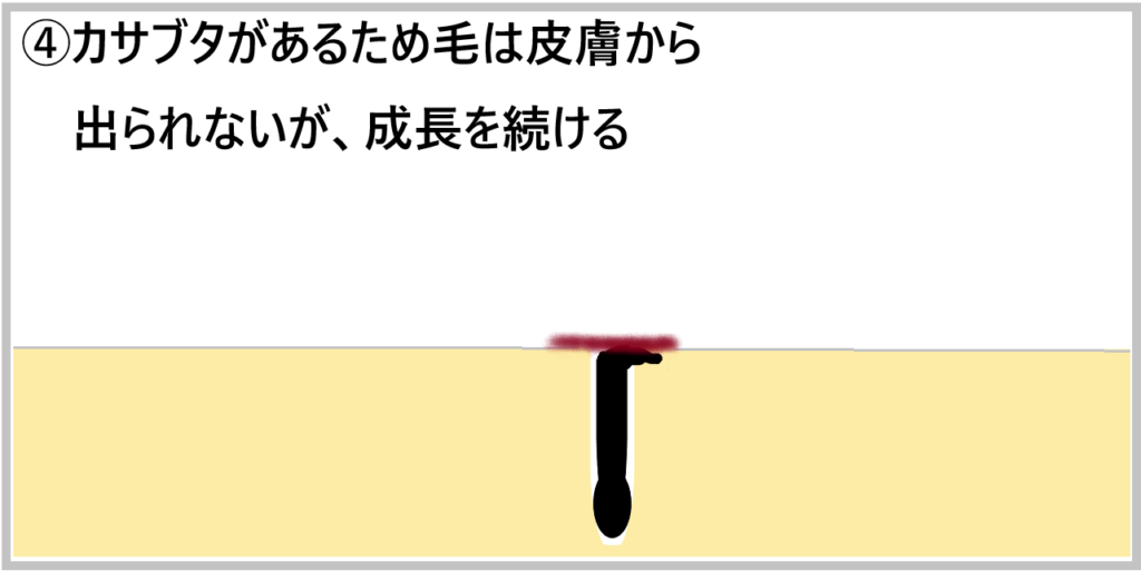 ④カサブタがあるため毛は皮膚から出られないが成長を続ける画像