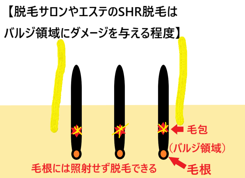 脱毛サロンやエステのSHR脱毛はバルジ領域にダメージを与える程度ということを示した画像