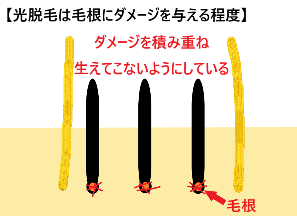 光脱毛はダメージを与える程度