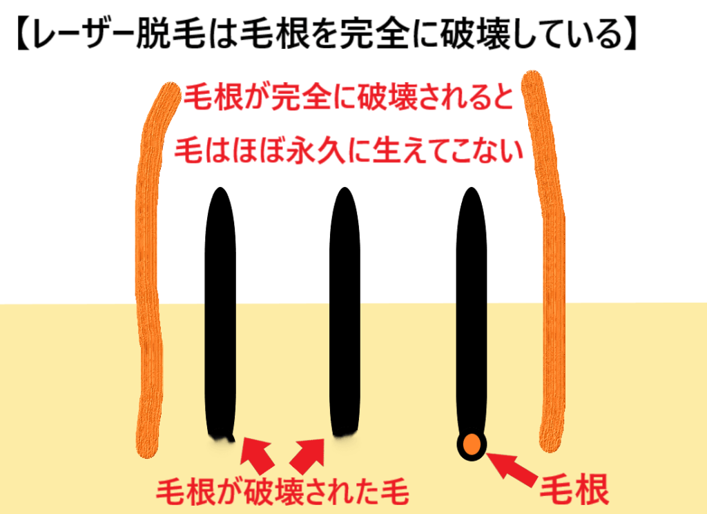 レーザー脱毛は毛根を完全に破壊していることを示した画像