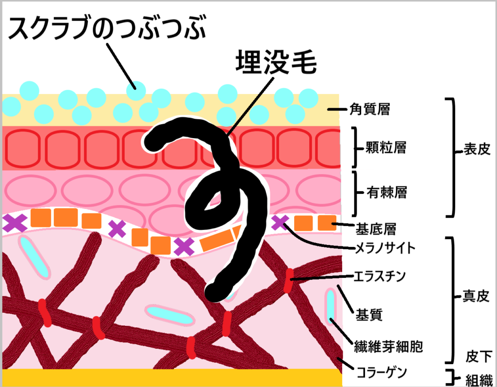 ①スクラブを使って埋没毛を処理する図