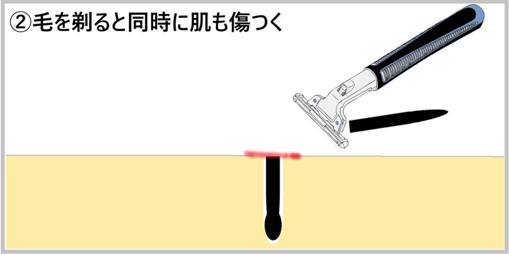 ②毛を剃ると同時に肌も傷つく画像