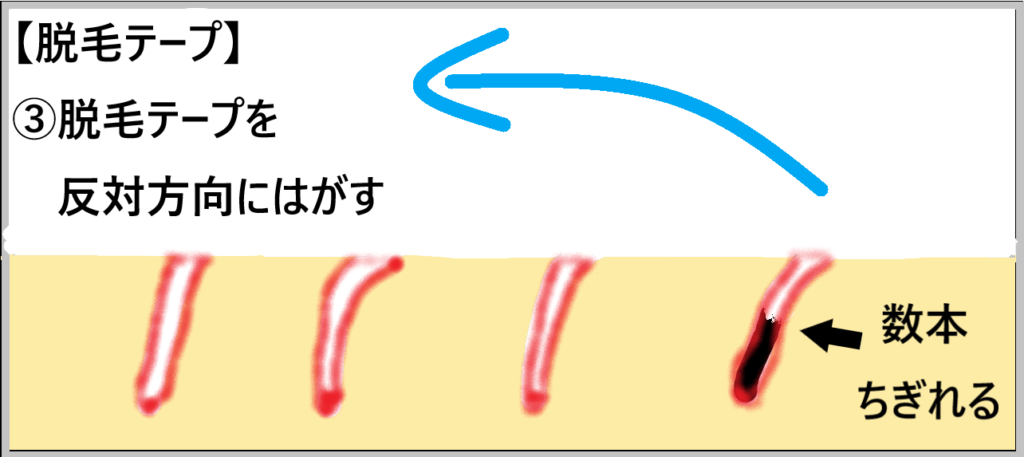 ③【脱毛テープ】脱毛テープを反対方向に剥がすとどうなるか示した画像