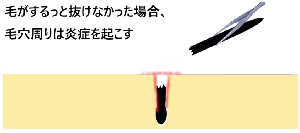 毛抜きで毛を抜いてするっと抜けなかった場合どうなるかを示した画像