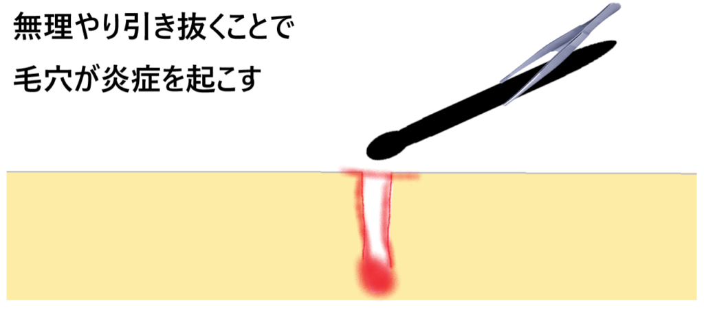 無理やり引き抜くことで毛穴が炎症を起こす