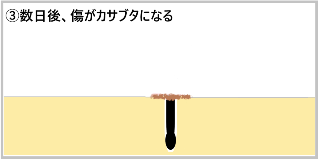 ③数日後、傷がカサブタになる画像