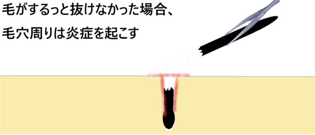 毛を引き抜く際に、毛が途中でちぎれ炎症を起こす