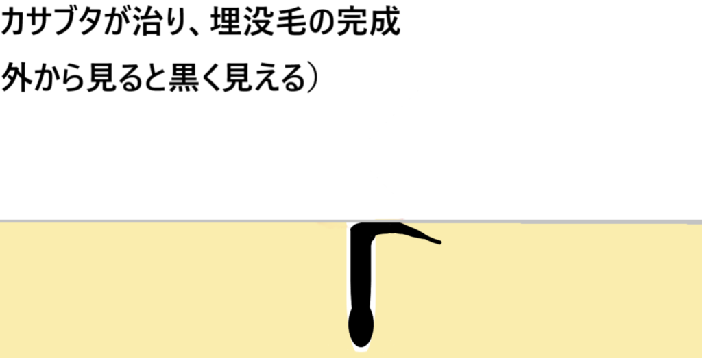 毛が皮膚の下で伸び続け、黒いポツポツになる